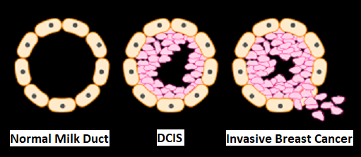 Normal-Milk-Duct DCIS Invasive-Breast-Cancer