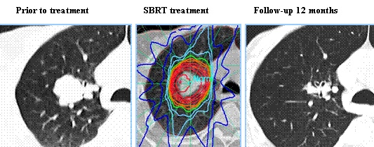 SBRT-Treatment